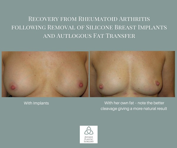 fat transfer