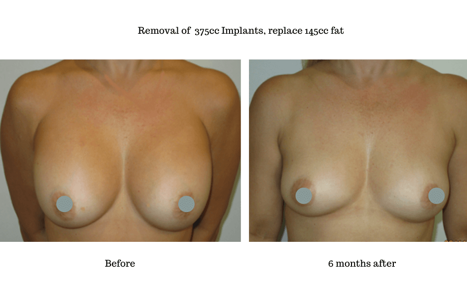 Before-Removal-and-Replacement-of-incorrectly-placed-silicone-gel-implants - 1