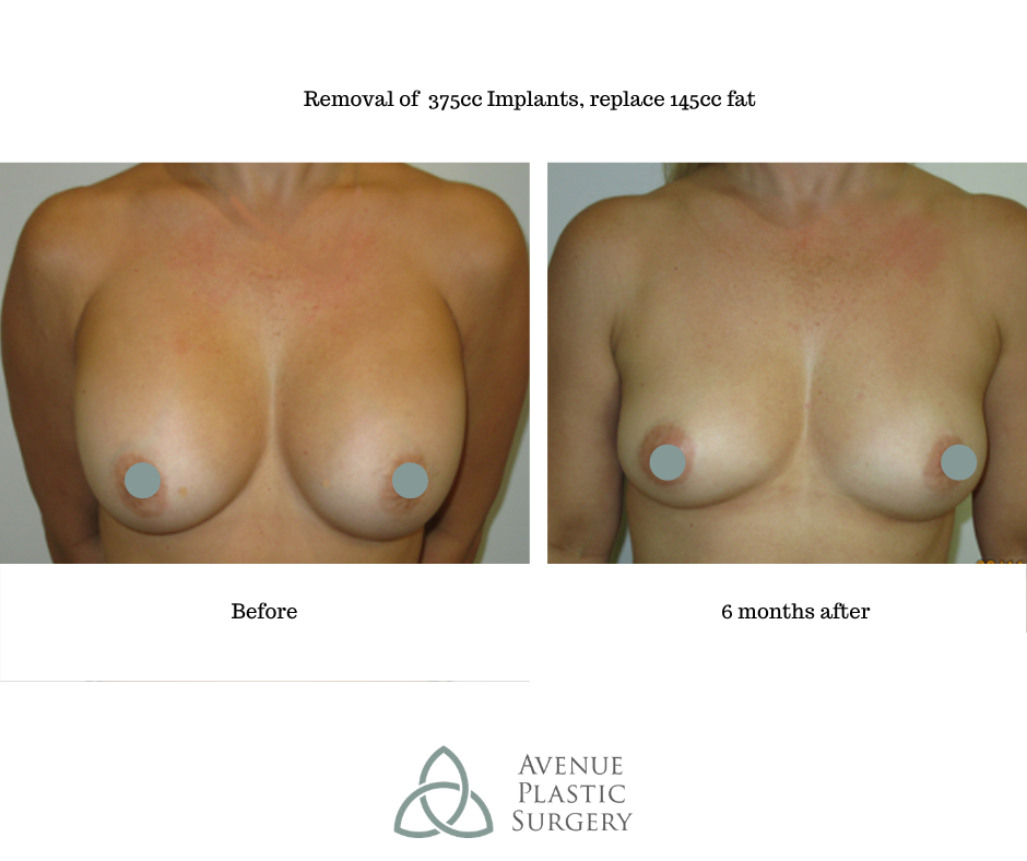 Removal of Breast Implants - 2
