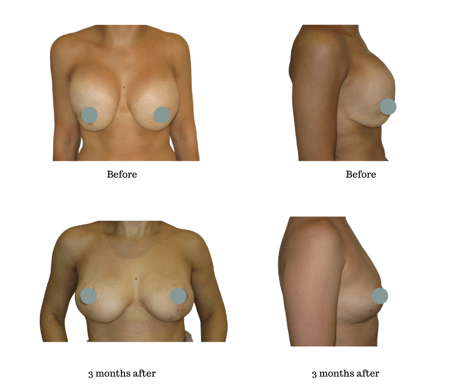 Removal-and-Replacement-of-incorrectly-placed-silicone-gel-implants - 1