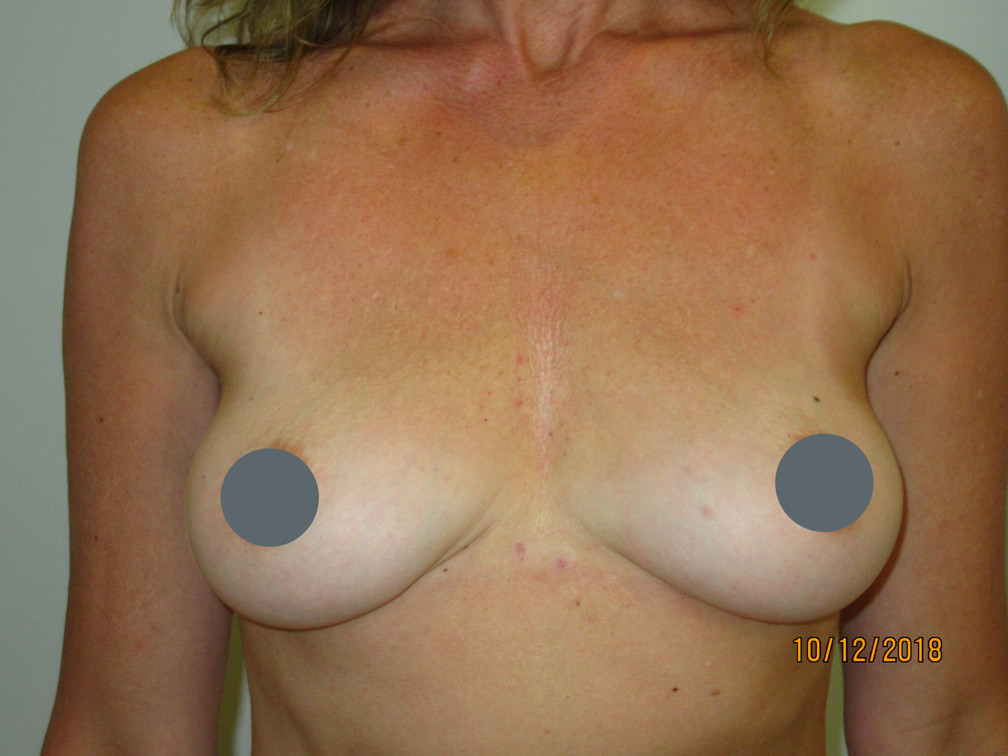 avenue-plastic-surgery-gallery-case6-01 - 50