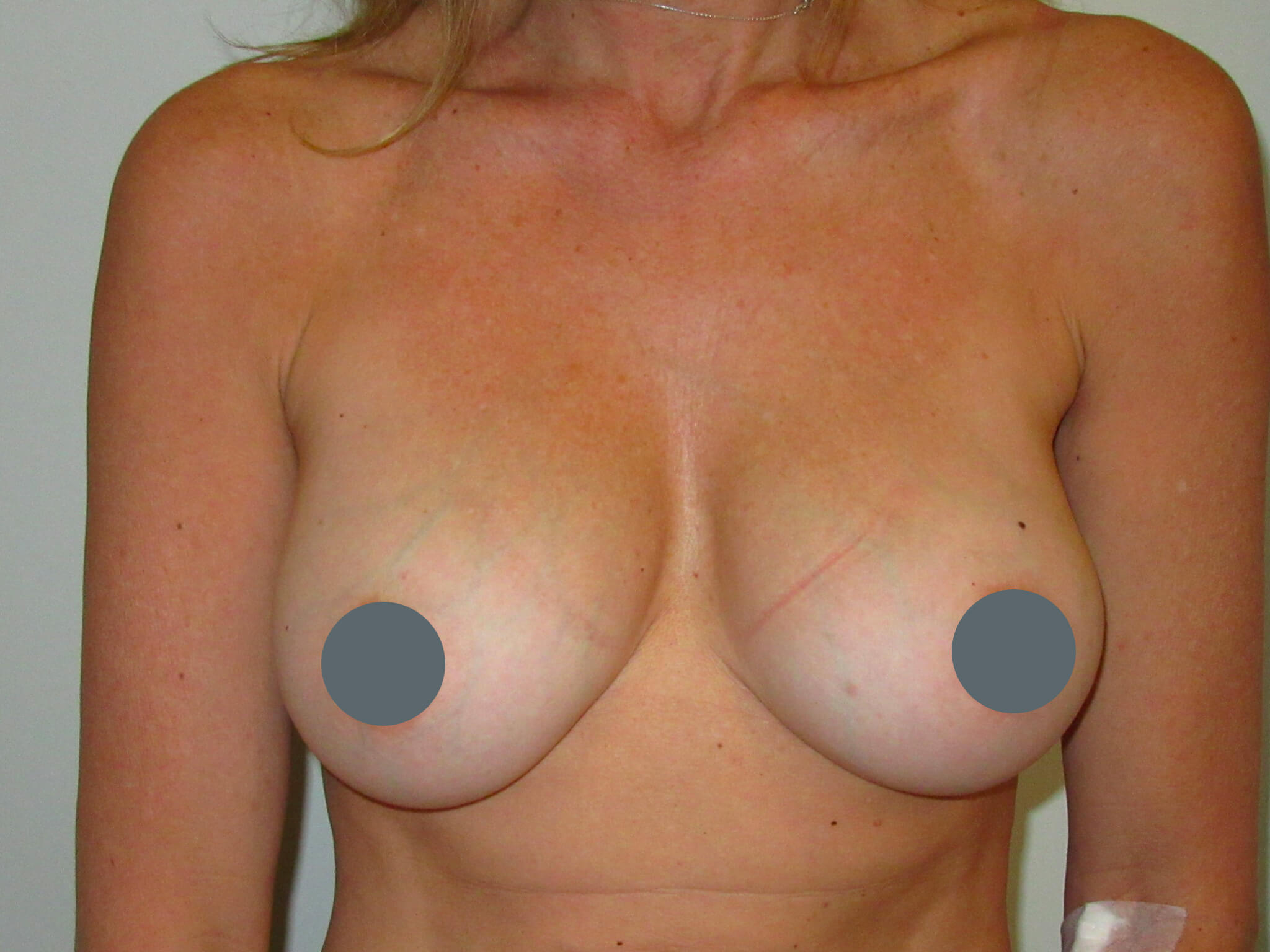 avenue-plastic-surgery-gallery-case6-02 - 49