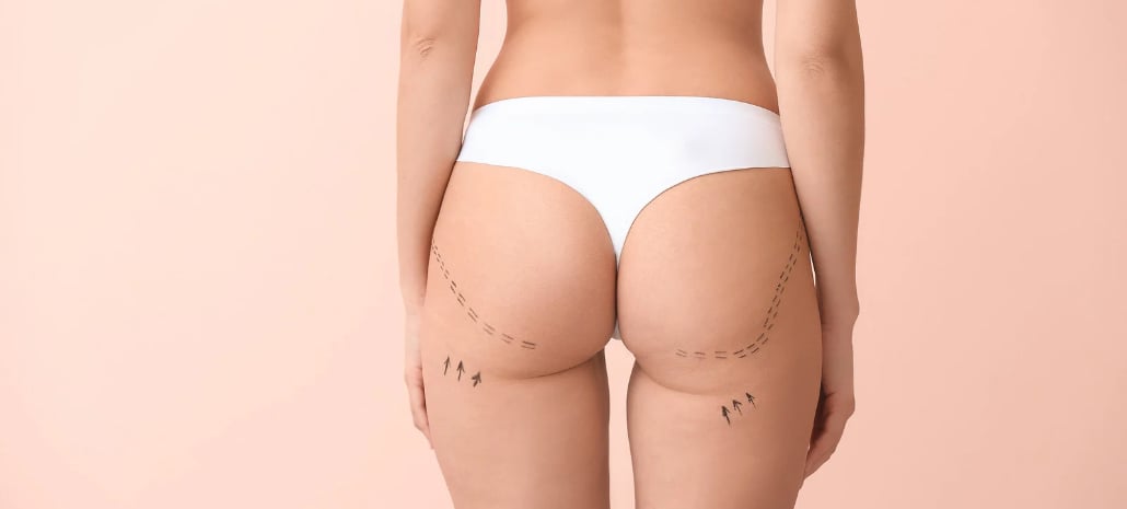 Surgical markings on the body indicating liposuction treatment areas, illustrating the procedure discussed in the article