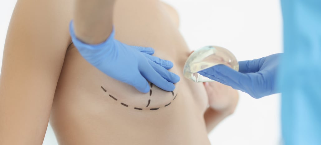 Surgical markings and a breast implant during preparation for surgery, relating to safety alerts about breast implants