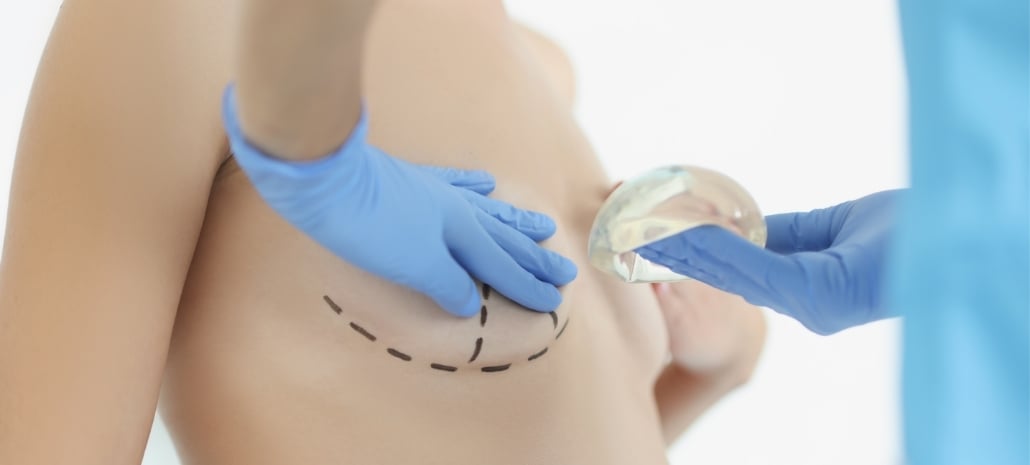 Surgeon holding a breast implant next to marked incision lines, illustrating the choice between implants and fat transfer