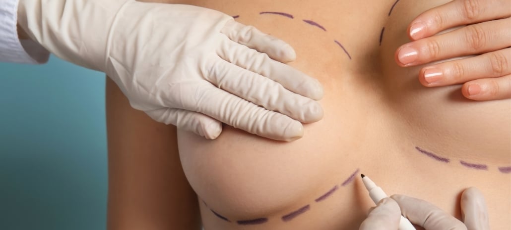 Surgeon marking incision lines on a patient before breast implant surgery